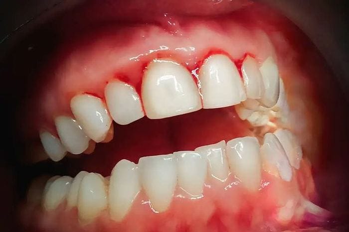 Gum Disease Care