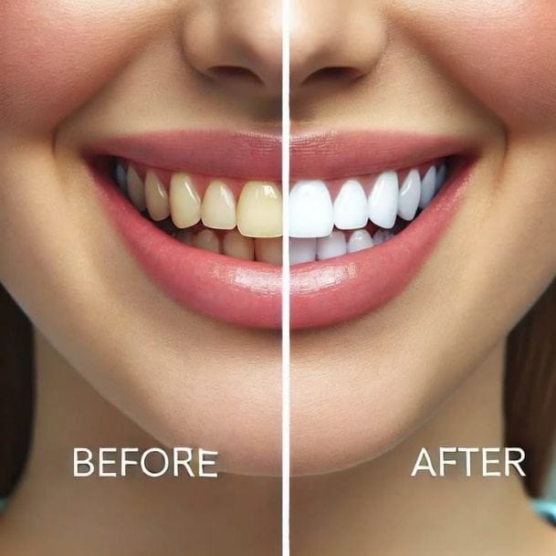 Teeth Whitening