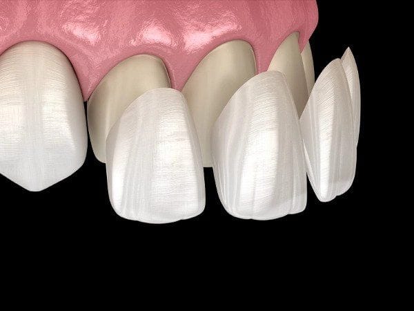 Veneers 1