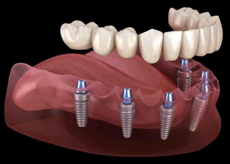 Dental Implants 1