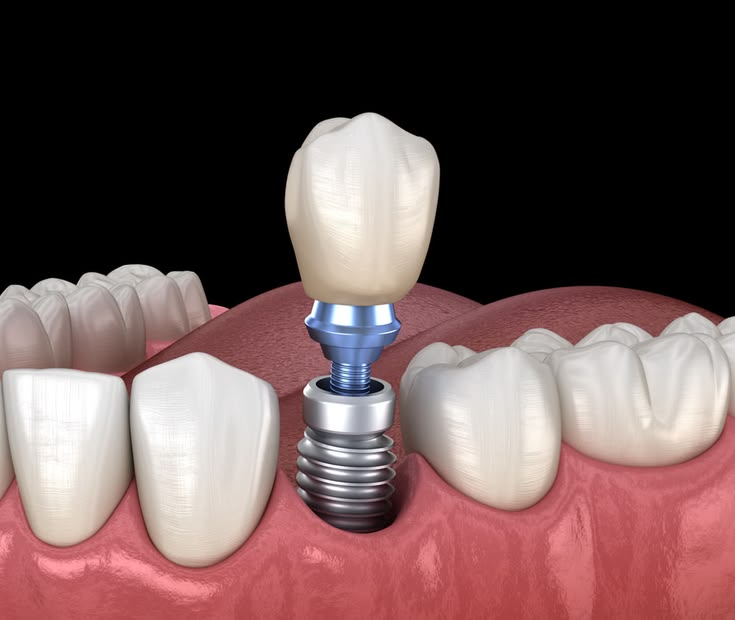 Dental Implants 2