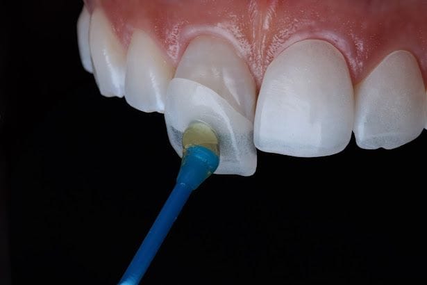 Veneers 2